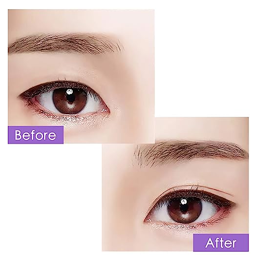 EYELID